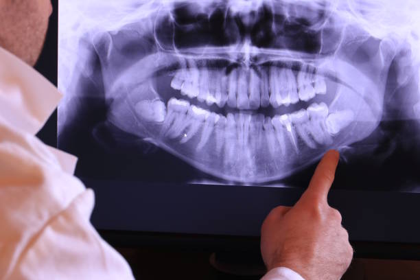 Best Emergency Wisdom Teeth Removal in Garrison, ND